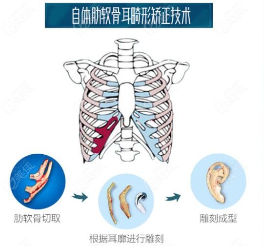 北京煤医小耳畸形矫正手术优势