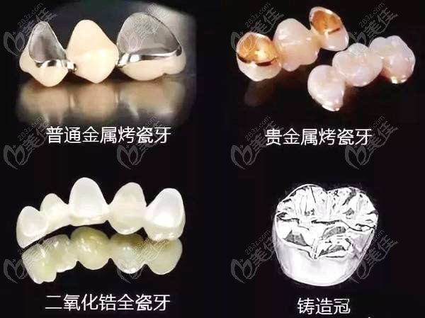 不同牙冠的对比