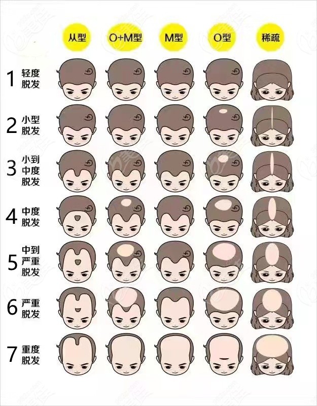 脱发程度判断图例，有1-7个等级。