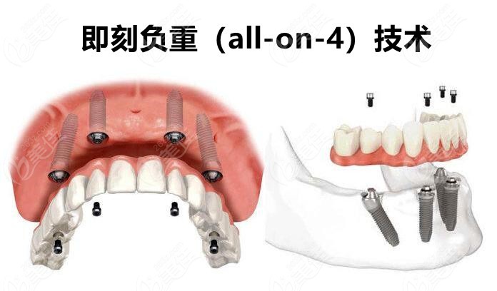 半全口种植牙技术：all-on-4