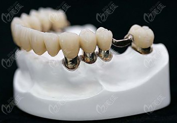 剩下两个基牙能做套筒冠义齿