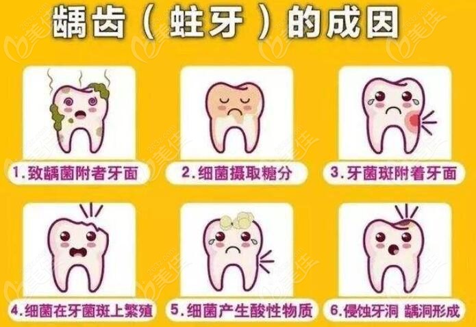 蛀牙是怎么形成的？