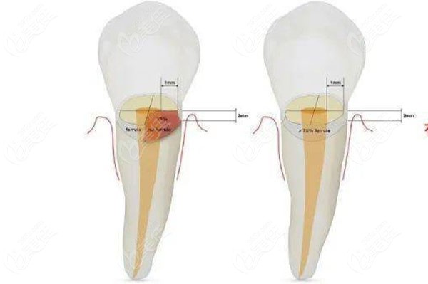 牙冠延伸手术