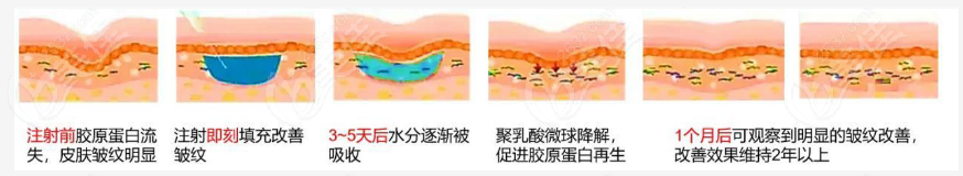 艾维岚童颜针的作用原理