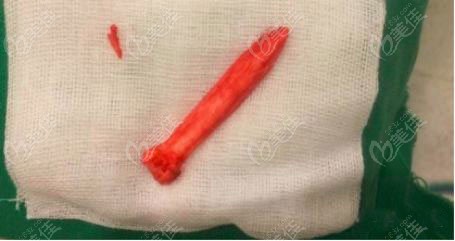 膨體隆鼻一年半感染取出假體 膨體隆鼻一年半感染取出假體