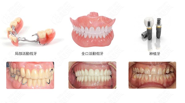 连续缺三颗牙比较好的治疗方法是什么