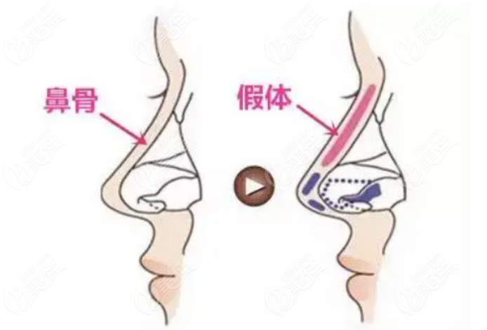 李岳令医生发明了“五段机仿生结构隆鼻手术”