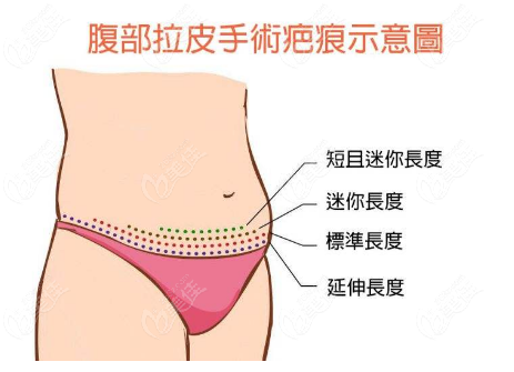 腹部大拉皮手术疤痕大小示意图