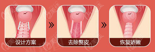 阴道紧缩过程展示图