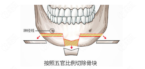 凸嘴下巴后缩需要做下巴T型截骨前移矫正