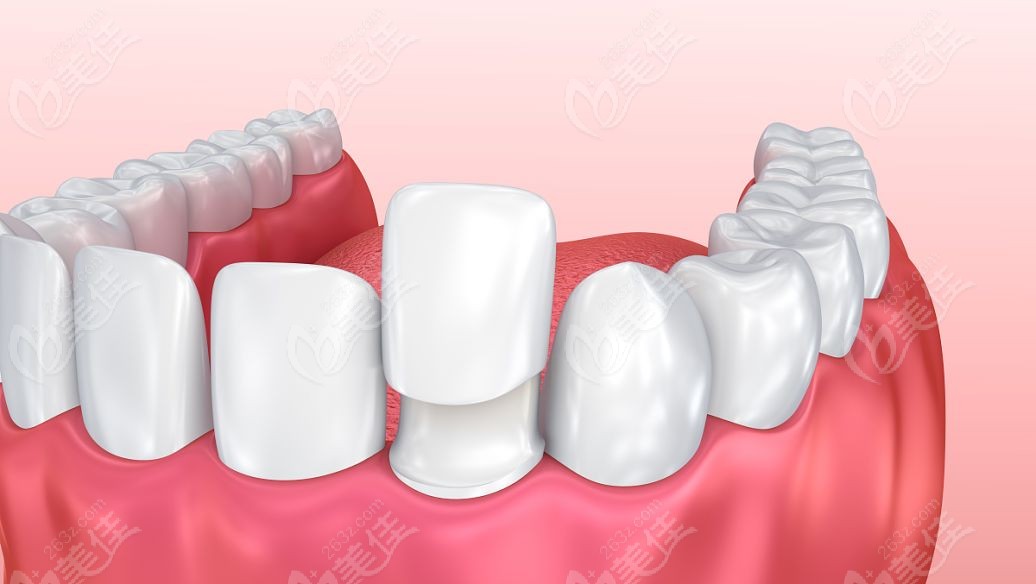 牙齒貼面需要打麻藥嗎