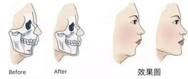 骨性凸嘴正颌手术过程图解