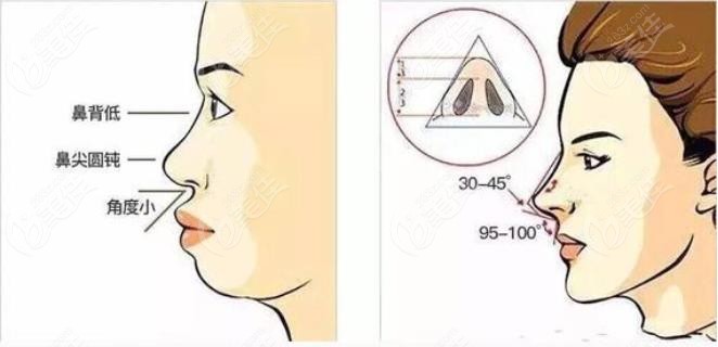 鼻基底凹陷可以通过做正畸改善