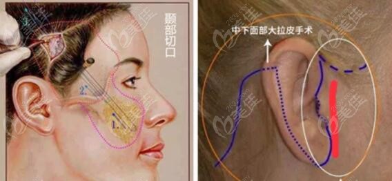 面部拉皮手术之大小拉皮的区别