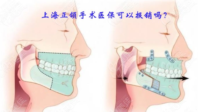 上海正颌手术医 保可以报销吗
