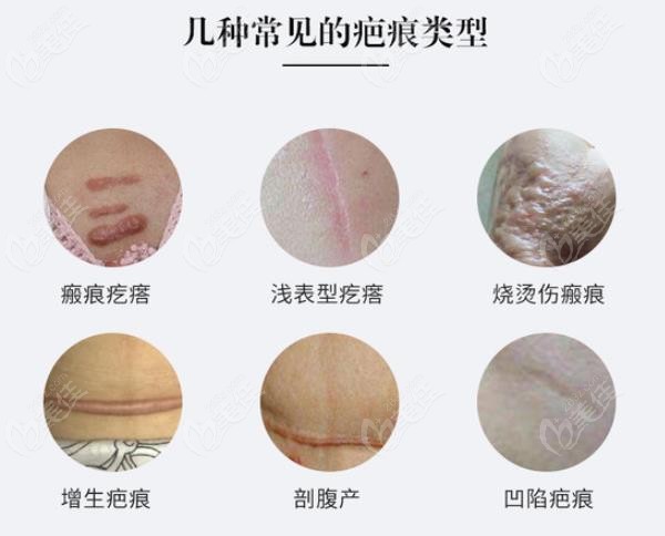 成都治疗凹陷性疤痕多少钱