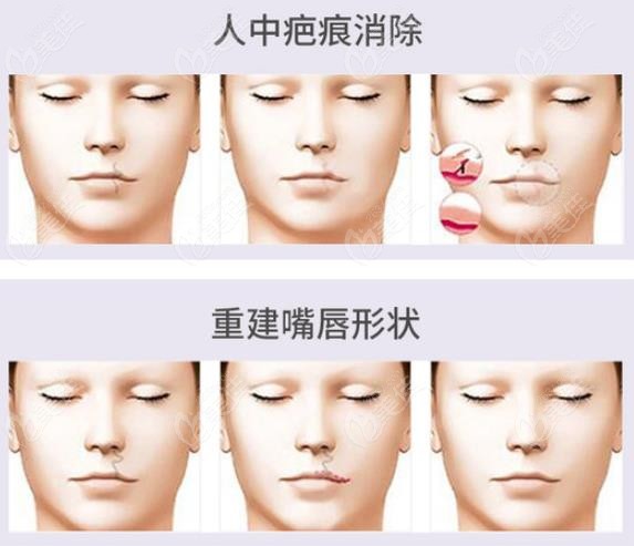 成都修复成人唇裂疤痕的价格