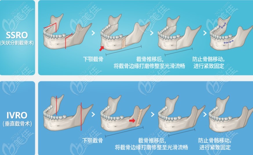 下颌手术（下颚手术）方法解析