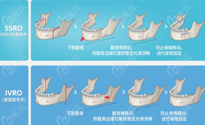 小下颌一定要手术吗图片