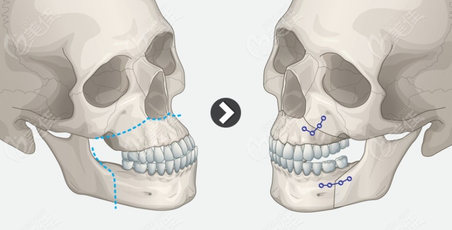 双颌手术过程图解