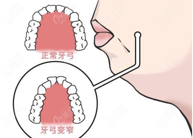 牙弓窄一定要进行扩弓治疗吗？