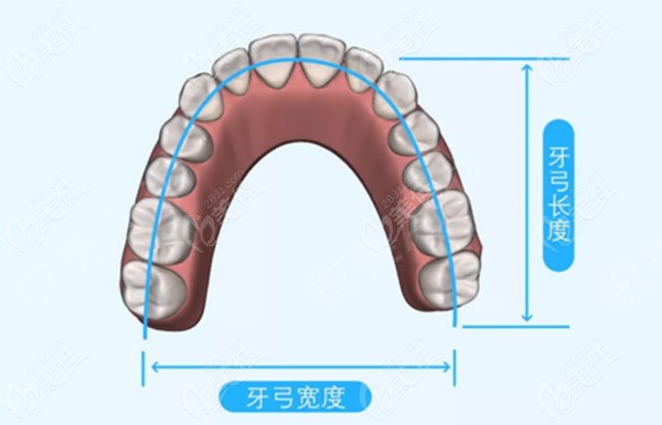 牙齿扩弓的作用是什么