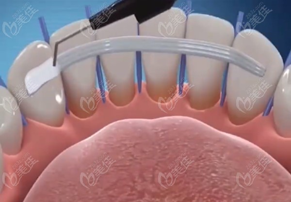 松动牙固定术是什么