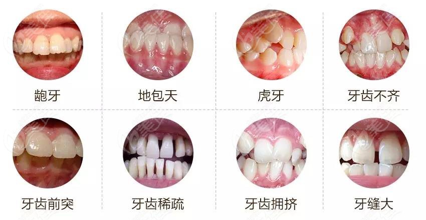 牙齿畸形的症状有哪些？