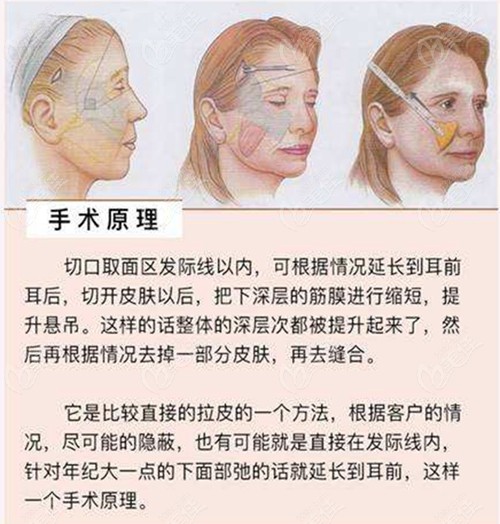 冯晓玲医生做面部拉皮过程