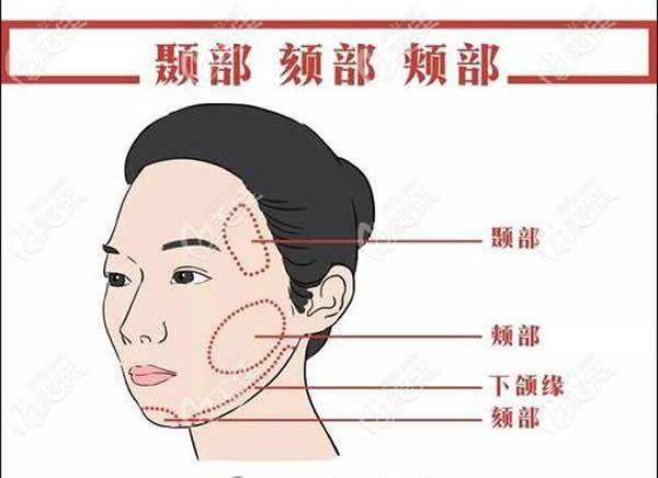 武汉大拉皮手术可以改善面部