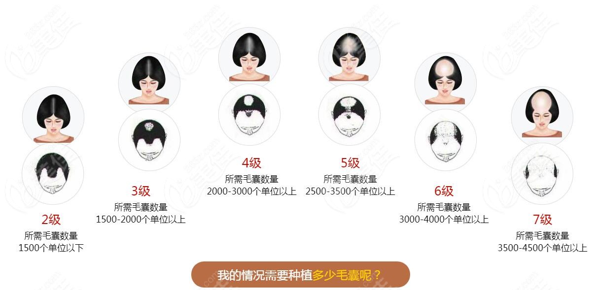 脱发等级示意图