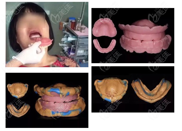 全口吸附性活动义齿的制作过程
