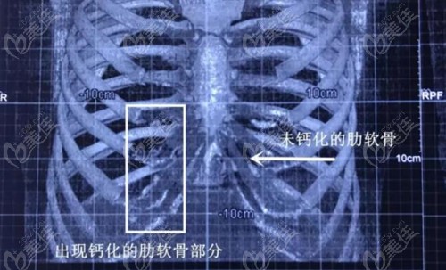 CT下能看清楚肋骨钙化情况