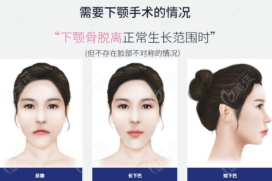 下颌手术适应人群