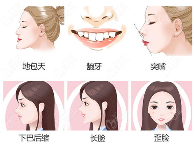 正颌手术适应症有哪些