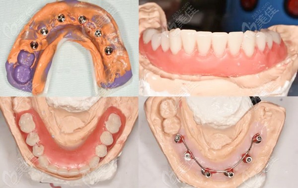 手术完成同时取模并制作临时义齿