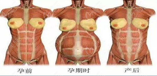 腹壁成型术的过程