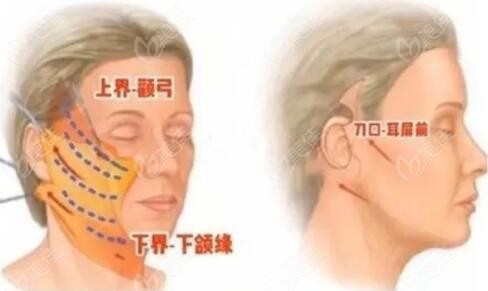 筋膜悬吊术可以做几次啊