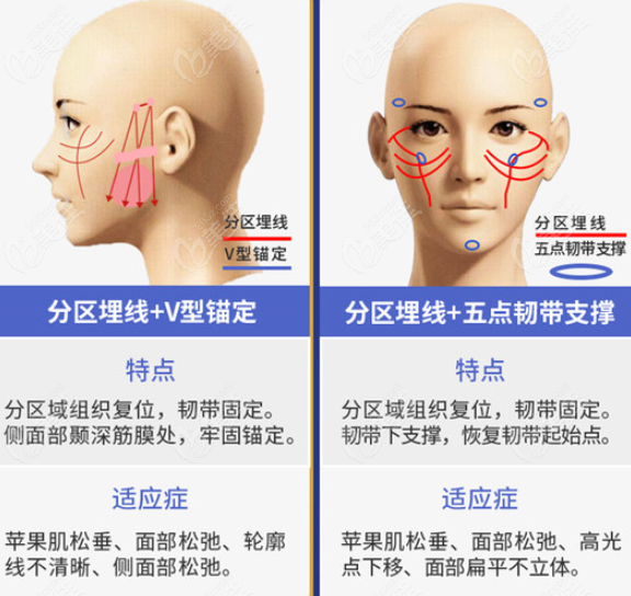面部埋线提升布线的方式