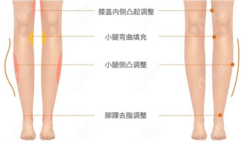 直腿成型术是什么呢?