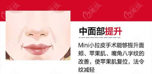 小切口拉皮提升苹果肌