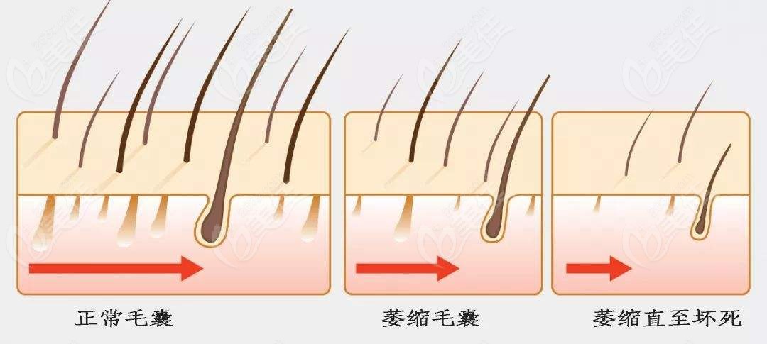 毛囊萎缩过程图