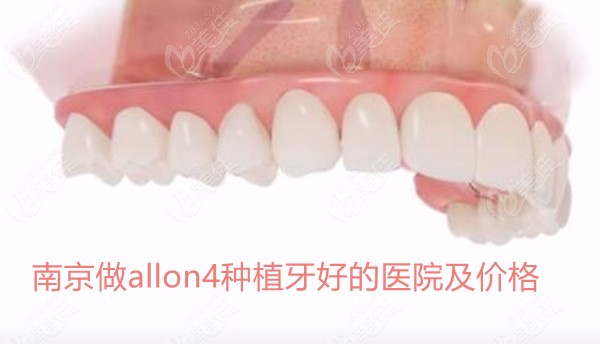 南京做allon4种植牙好的医院