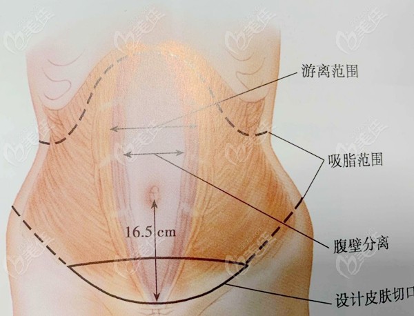 腹壁成型手术方案设计