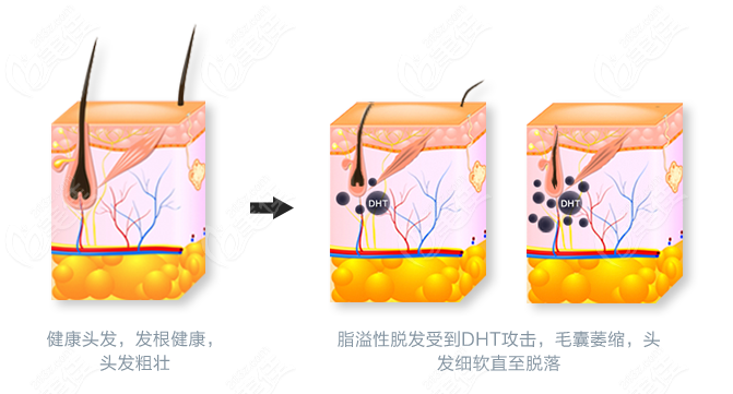 脂溢性脱发原因