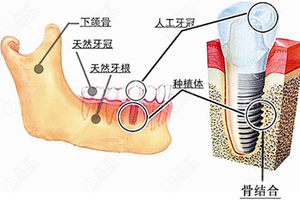 种植牙的分解图