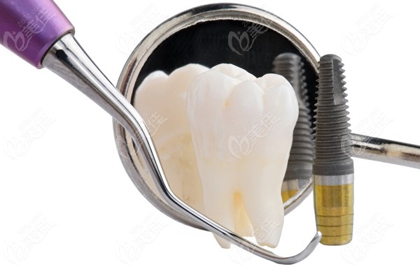 民营牙科医院种牙收费标准