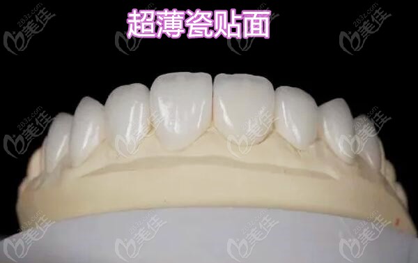 超薄瓷貼面示意圖