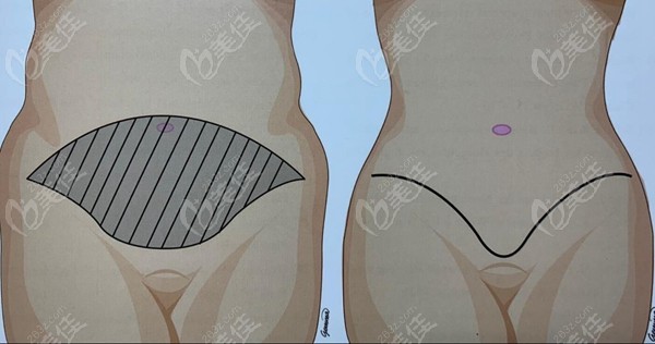 腹壁成型手术术前手术设计
