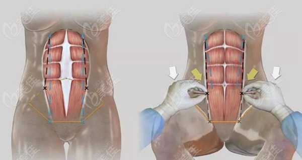 腹壁成型手术剥离组织过程